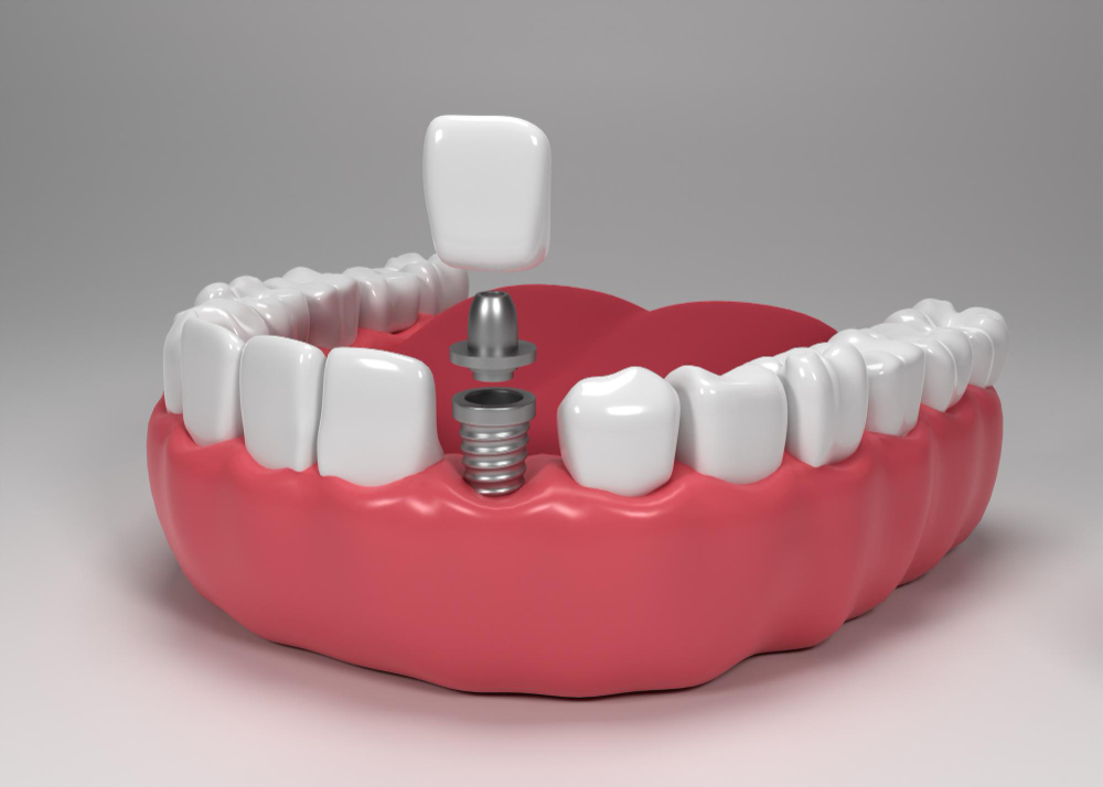 Dental_IMplant_21